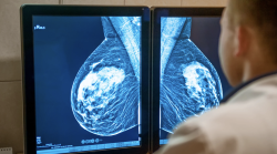 Mammografia senza referto dopo 66 giorni: "Recuperato solo per caso. Prevenzione utile solo se tempestiva" 