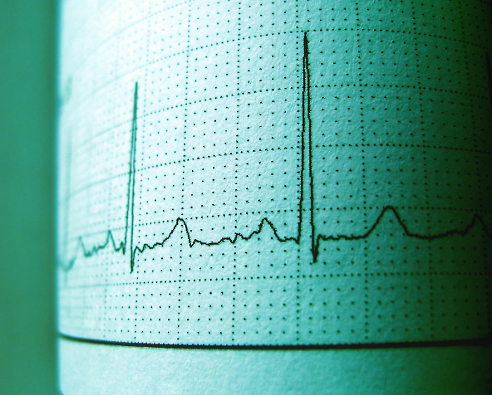 Elettrocardiogramma