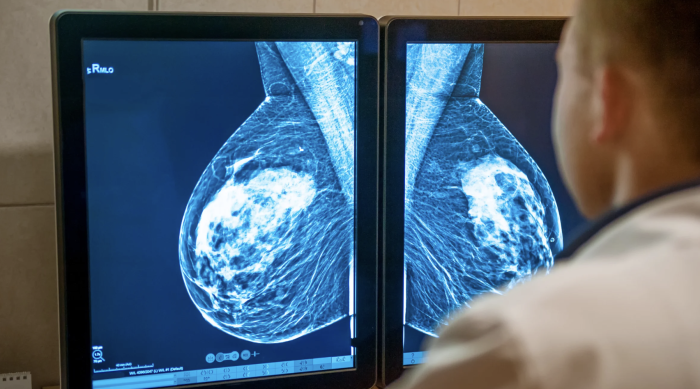 Mammografia senza referto dopo 66 giorni: "Recuperato solo per caso. Prevenzione utile solo se tempestiva" 