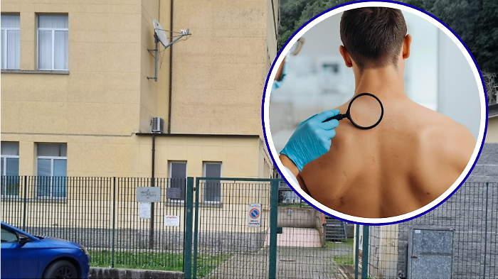 Screening dermatologico gratuito, visite aperte a tutti:  ecco come prenotarsi e chi pu&ograve; partecipare